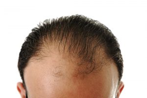 Androgenetic Alopecia