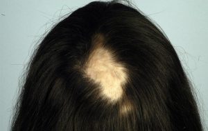 Alopecia Areata