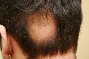 Alopecia Areata